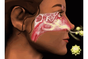 Xông mũi họng cho trẻ đúng cách